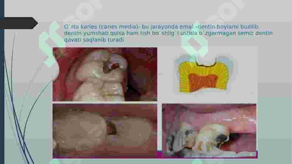 O`rta karies