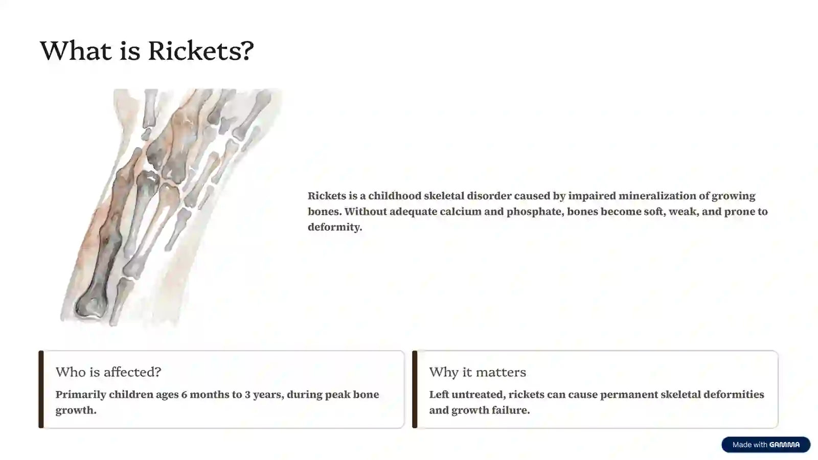Rickets: Understanding the 